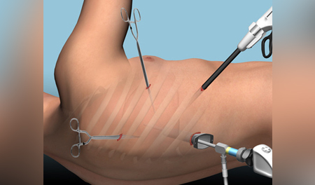 Thoracoscopy (Video-Assisted Chest Surgery)