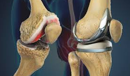 Joint Replacement Surgery